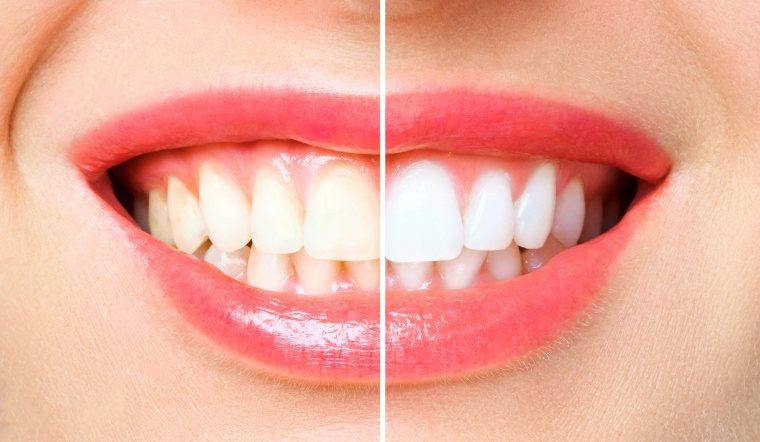 Loại bỏ mảng bám là 1 phần của chăm sóc sức khỏe răng miệng