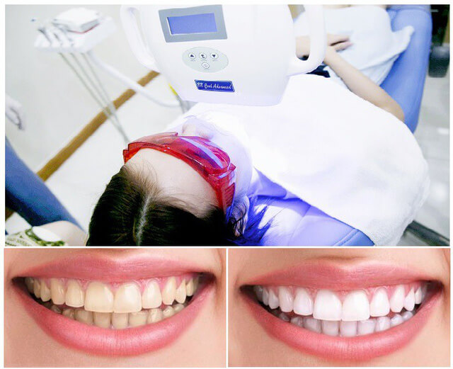 Các yếu tố ảnh hưởng giá của tẩy trắng răng